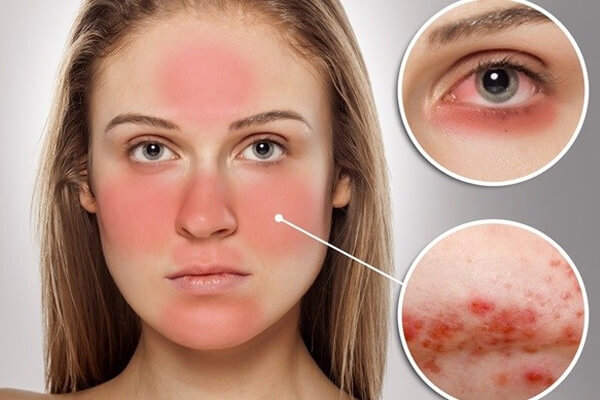 Lupus ban đỏ là bệnh gì